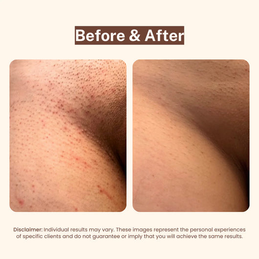 Bikini Line Serum